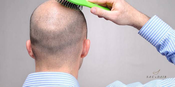 Erkek Tipi Saç Dökülmesi: Nedenleri, Çözümleri ve Öneriler